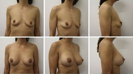 Augmentation mammaire - Dr Mathieu Piquet