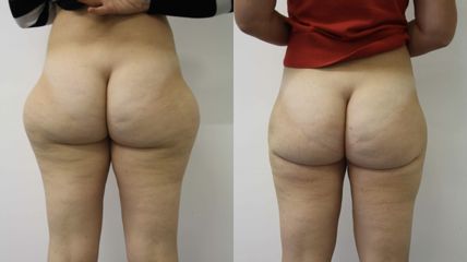 Lipoaspiration - Dr Mathieu Piquet