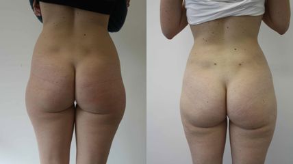 Lipoaspiration - Dr Mathieu Piquet
