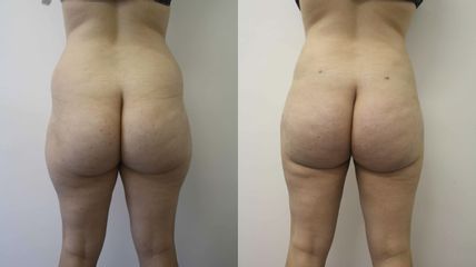 Lipoaspiration - Dr Mathieu Piquet