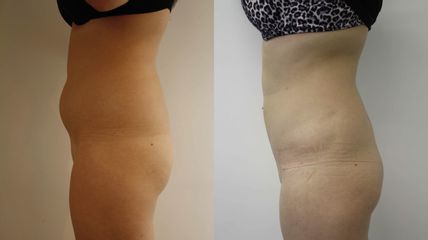 Lipoaspiration - Dr Mathieu Piquet