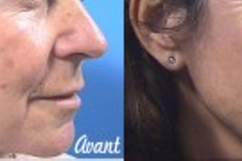 Laser dermatologique avant et après - 322522