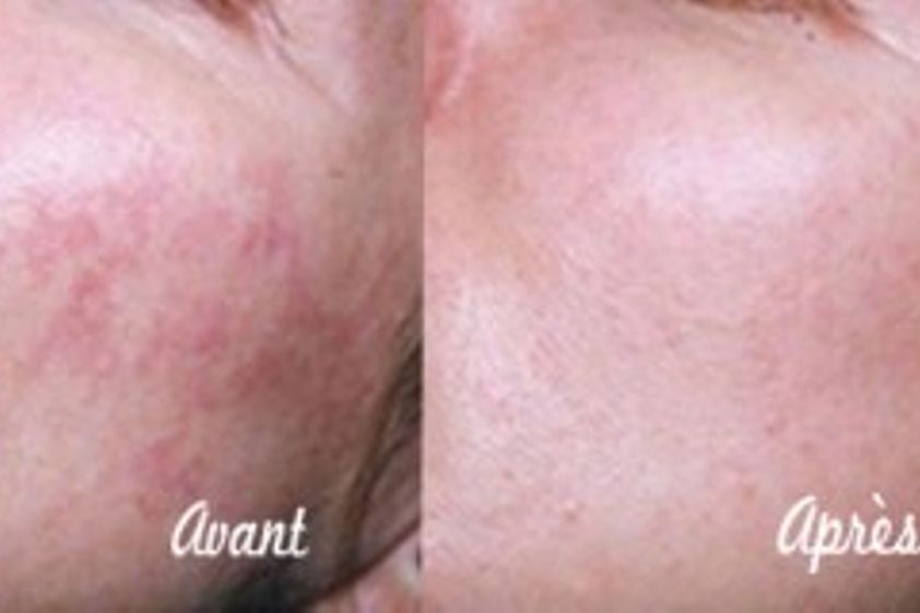 Laser dermatologique avant et après - 322523