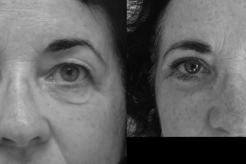 Blépharoplastie avant et après - 820477