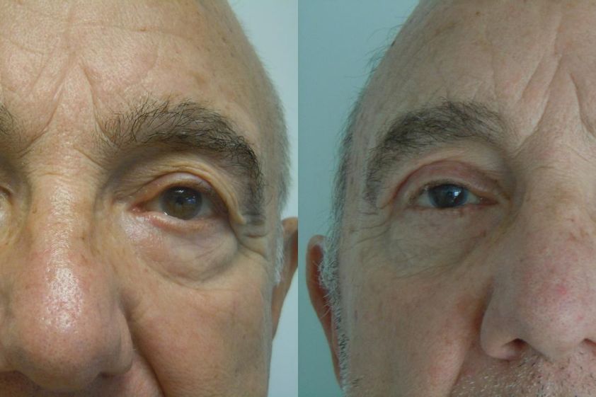 Blépharoplastie avant et après - 820479