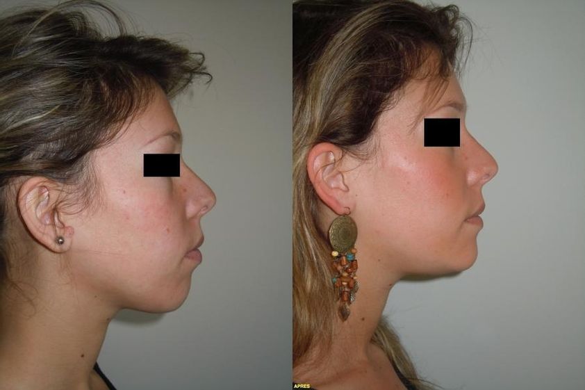 Chirurgie maxillo-faciale avant et après - 820483