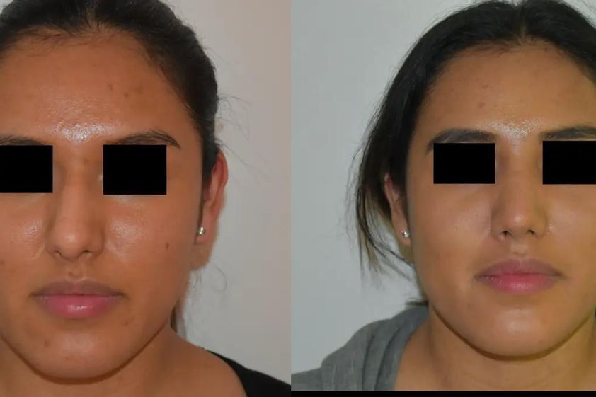 Rhinoplastie avant et après - 820485