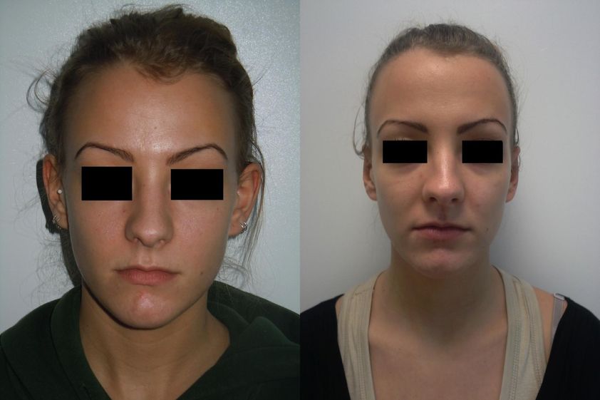Otoplastie avant et après - 820487
