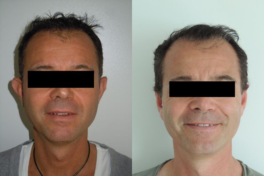Otoplastie avant et après - 820488