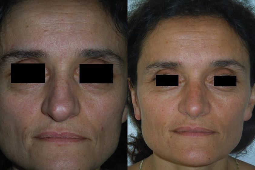 Rhinoplastie avant et après - 820491