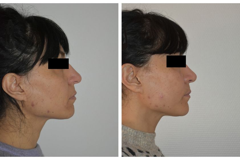 Rhinoplastie avant et après - 821509