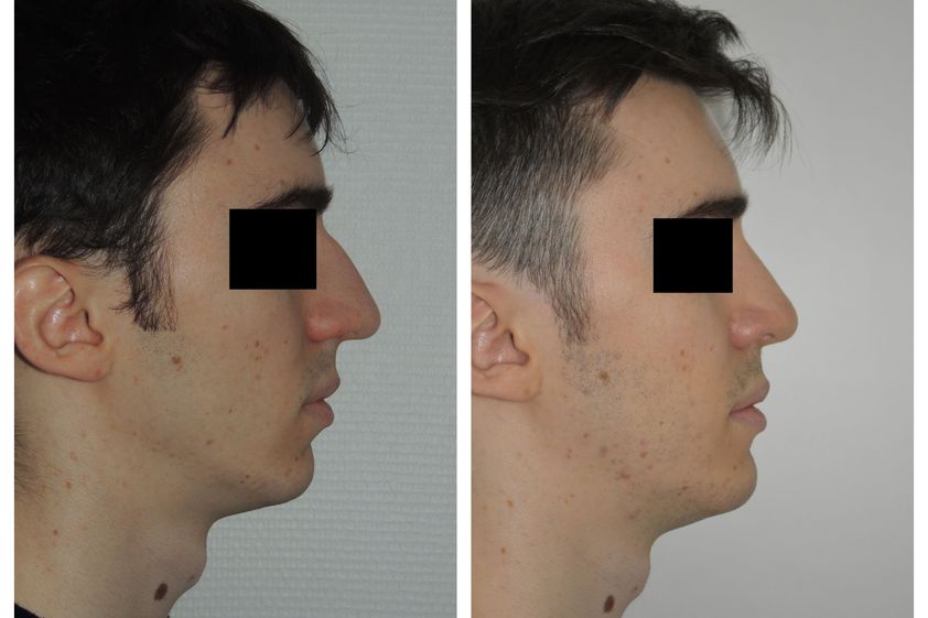 Rhinoplastie avant et après - 821515