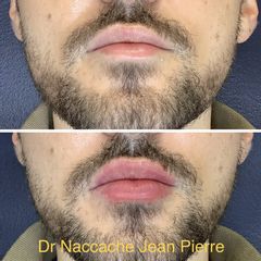 Augmentation des lèvres - Dr Jean-Pierre Naccache