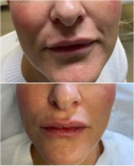 Augmentation des lèvres - Dr Joseph Rebot