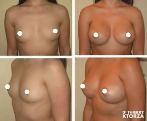 Augmentation mammaire - Dr Thierry Ktorza