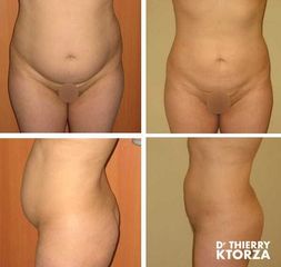 Liposuccion - Dr Thierry Ktorza