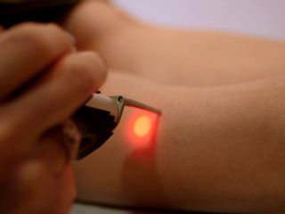 Épilation laser