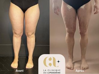 Liposuccion avant et après - 878674