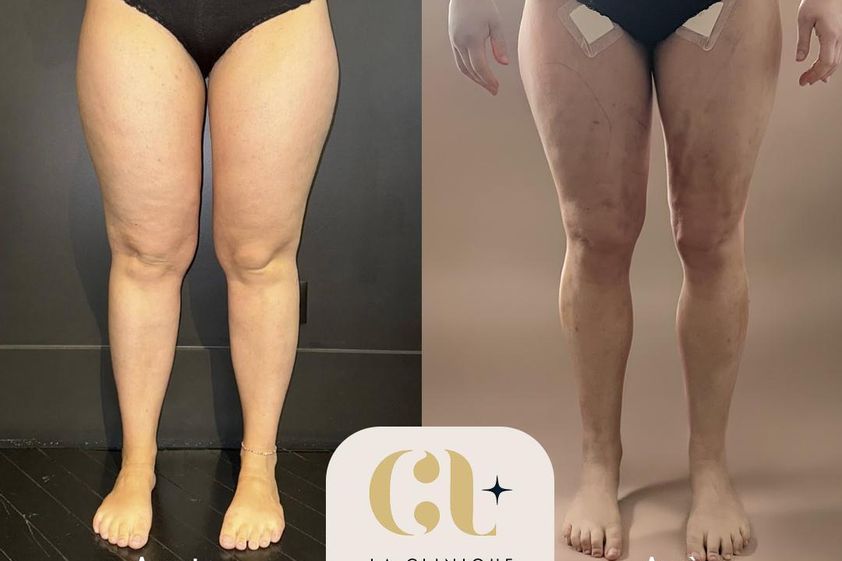 Liposuccion avant et après - 878674