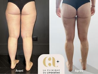 Liposuccion avant et après - 878676