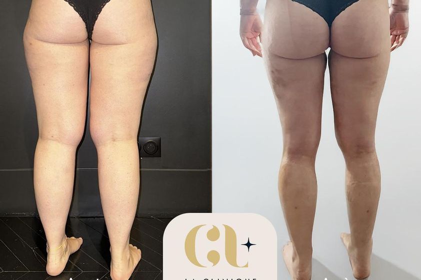 Liposuccion avant et après - 878676