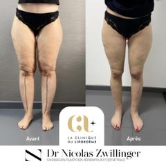 La Clinique du Lipœdème