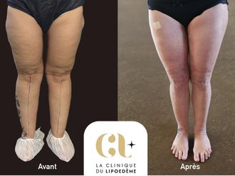 Liposuccion avant et après - 878678