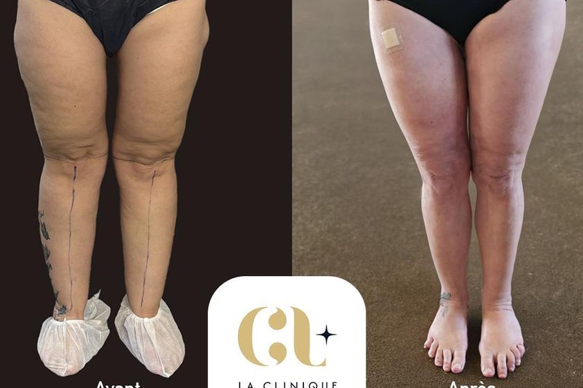 Liposuccion avant et après - 878678