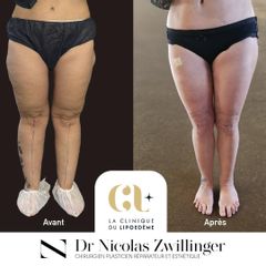 La Clinique du Lipœdème
