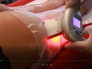 cryolipolyse - Dr. Pascal Didi