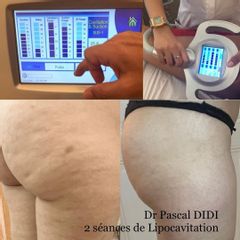 Traitement anti-cellulite - Dr. Pascal Didi