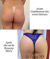 Acide hyaluronique - Dr. Pascal Didi