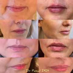 Augmentation des lèvres - Dr. Pascal Didi