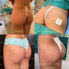 Acide hyaluronique - Dr. Pascal Didi