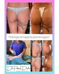 Acide hyaluronique - Dr. Pascal Didi