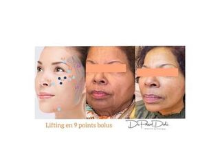 Lifting - Dr. Pascal Didi