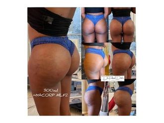 Traitement anti-cellulite avant et après - 812496