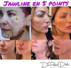 Lifting - Dr. Pascal Didi