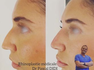 Rhinoplastie médicale avant et après - 872352