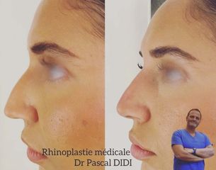 Rhinoplastie Médicale - Dr Pascal DIDI