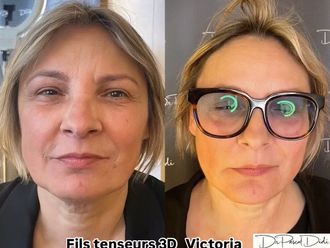 Fils tenseurs avant et après - 875042