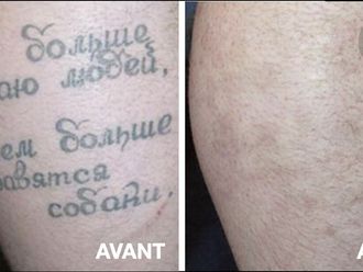 Détatouage avant et après - 867804