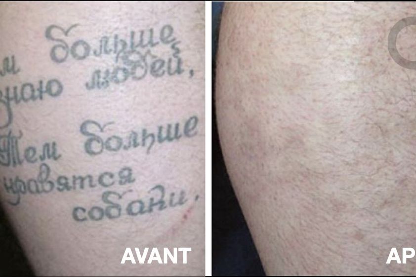 Détatouage avant et après - 867804