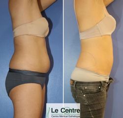 Cryolipolyse - Le Centre Esthétique