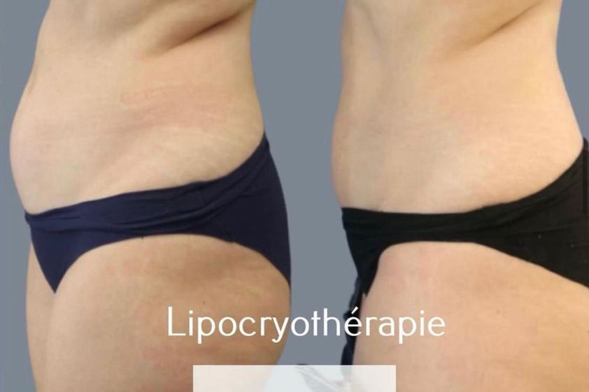 Cryothérapie avant et après - 831640