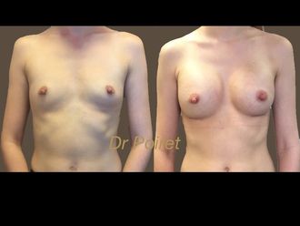 Augmentation mammaire - 633561
