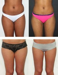 Avant après Lipoaspiration