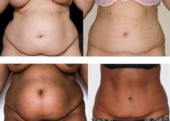 Avant après Plastie abdominale