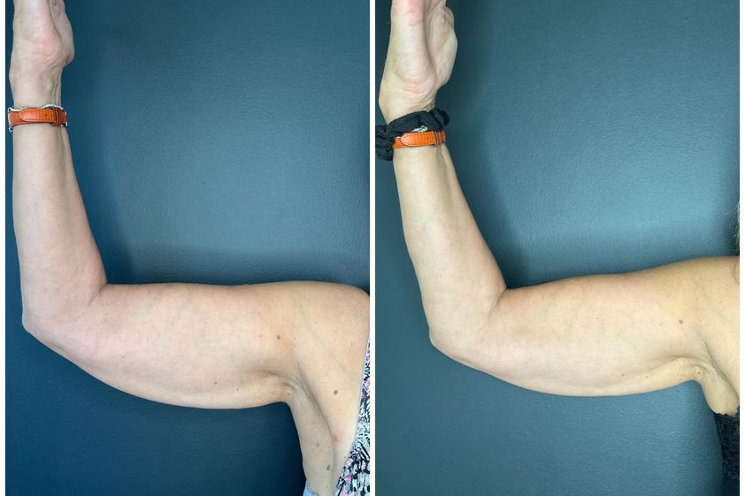Remodelage du corps avant et après - 866207