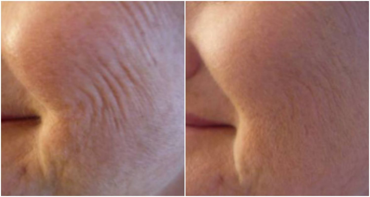 Mésothérapie Visage Avant Après